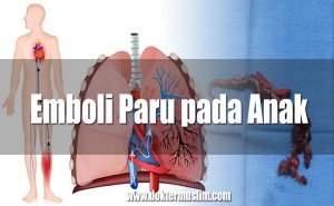 emboli paru pada anak
