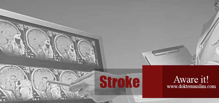 Jenis Stroke : Perbedaan Stroke Perdarahan dan Non Perdarahan