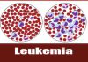 perbedaan leukemia akut dan kronis