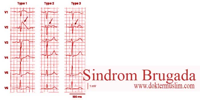 Sindrom Brugada : Gejala, EKG hingga Pengobatan