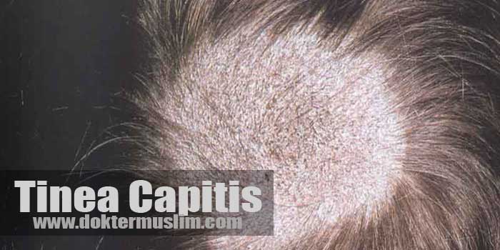 Tinea Capitis : Infeksi Jamur di Kepala