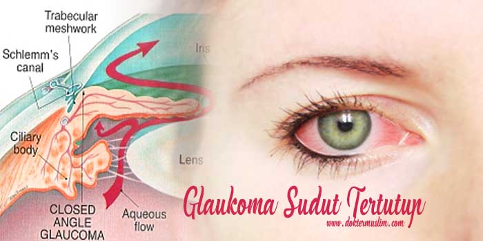 Glaukoma Sudut Tertutup : Jenis, Gejala Hingga Tatalaksana