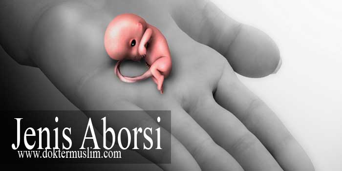 Keguguran : Jenis Aborsi hingga Pencegahannya