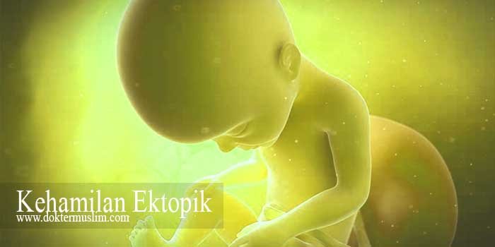 Kehamilan Ektopik : Gejala hingga Tatalaksana
