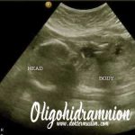 oligohidramnion