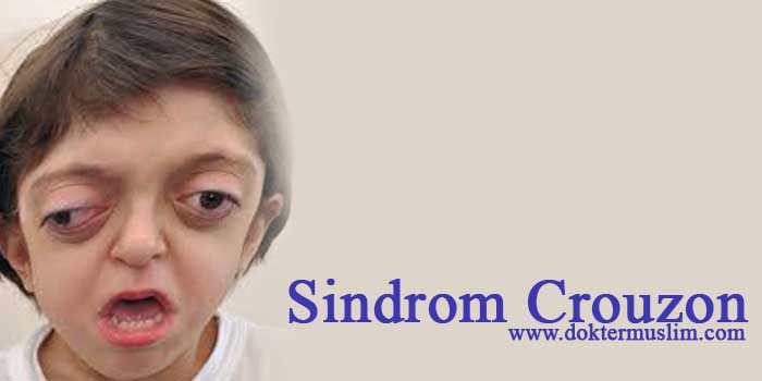 Sindrom Crouzon : Gejala hingga Tatalaksana