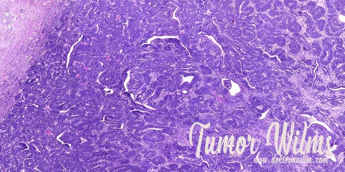 Tumor Wilms (Nefroblastoma) : Gejala hingga Tatalaksana