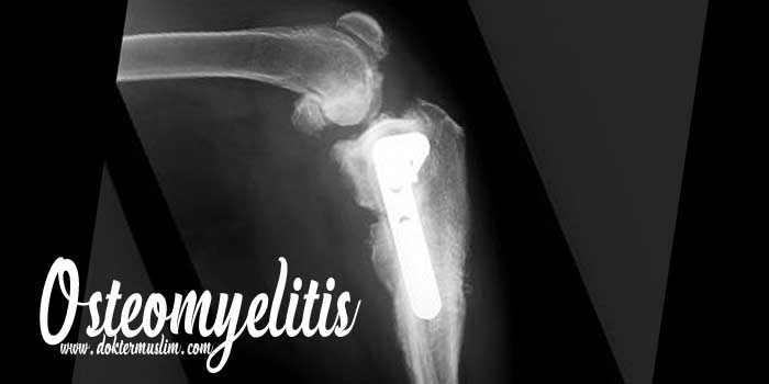 Osteomyelitis : Infeksi Tulang, Gejala hingga Tatalaksana