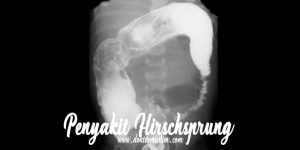 radiologi penyakit hirschsprung
