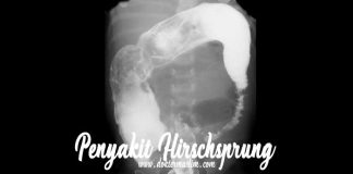 radiologi penyakit hirschsprung