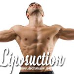Sedot lemak liposuction