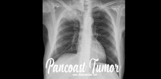 tumor pancoast