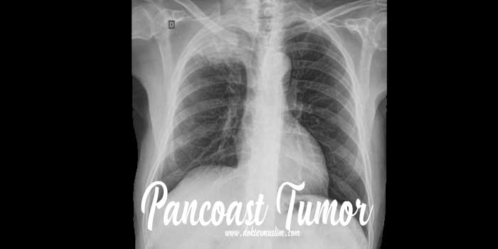 Tumor Pancoast (Kanker Paru): Gejala hingga Tatalaksana