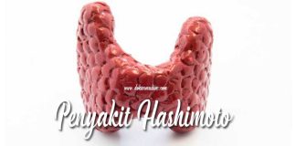 tiroiditis hashimoto