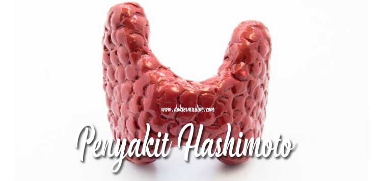  Tiroiditis Hashimoto : Penyebab, Gejala dan Tatalaksana