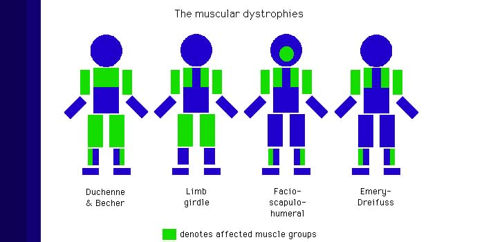 Perbedaan Duchenne dan Becker Muscular Dystrophy