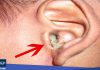 penyebab telinga bernanah