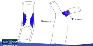 Perbedaan trombus dan emboli